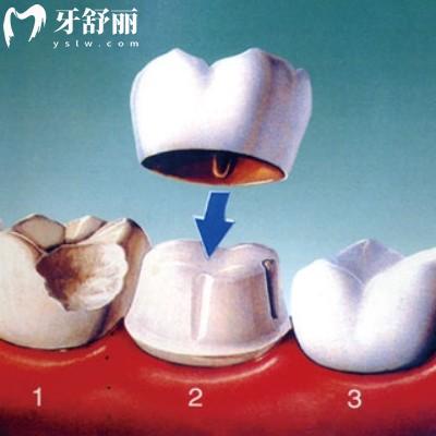 牙冠做了里面的真牙會(huì)不會(huì)慢慢爛？查收這份攻略牙冠多用幾年