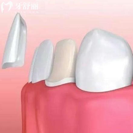 牙貼面需要磨損牙齒嗎?從價格/優(yōu)點和缺點看大約磨0.5-1mm左右可維持多年