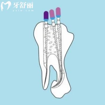 顯微鏡根管治療有必要嗎?揭曉什么樣的牙需要用顯微鏡治療