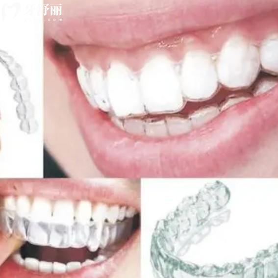 為什么隱形矯正那么貴？看完和金屬牙套的價格優(yōu)勢對比就明白了