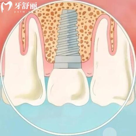 如何判斷種植牙是否成功？從術后使用中9大方面判斷