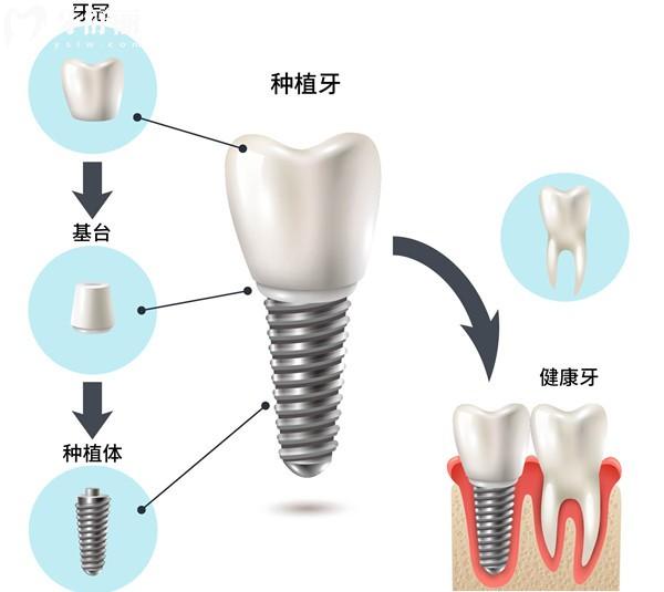 韓國(guó)桀諾GENO種植牙好不好？鈦合金材質(zhì)使用壽命長(zhǎng)價(jià)格挺實(shí)惠