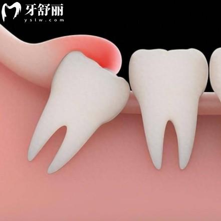 智齒會(huì)不會(huì)擠壓種植牙？雖然不會(huì)但其他不利影響要注意