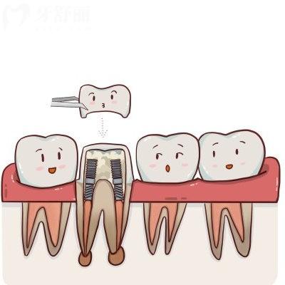 根管治療到底是怎么回事？帶你揭秘根管治療的作用及目的