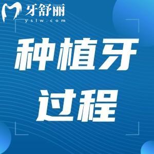 種植牙過(guò)程圖片一覽:詳細(xì)步驟和手術(shù)時(shí)間還有注意事項(xiàng)要了解