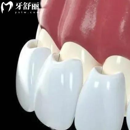 戴瓷貼面牙齒能用幾年？一般數(shù)年之久延長(zhǎng)使用壽命就看這幾點(diǎn)