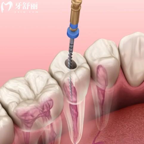 為什么根管治療完牙還會(huì)疼，盤點(diǎn)不補(bǔ)牙的五大不可逆危害