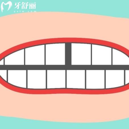 孩子換牙門牙牙縫大怎么辦？兒童牙齒不齊的解決方法需收好