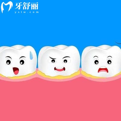 后槽牙適合戴哪種牙冠?帶你了解全瓷牙冠還是烤瓷牙冠好?