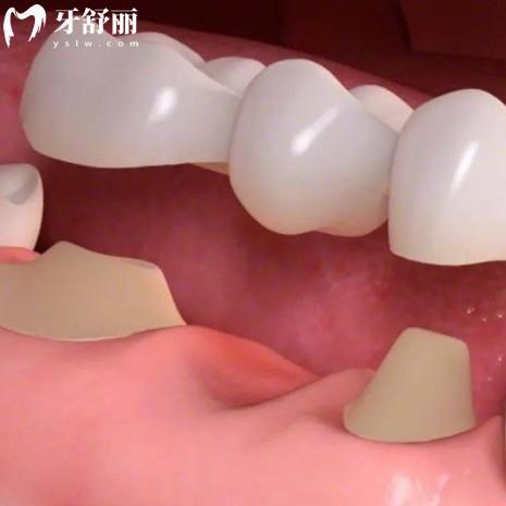 牙貼面和牙冠哪個(gè)好？從優(yōu)勢(shì)/價(jià)格/缺點(diǎn)等多方面對(duì)比