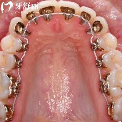舌側(cè)矯正牙齒是不是很遭罪?了解完舌側(cè)矯正的優(yōu)缺點及適應癥便知