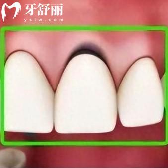 烤瓷牙套里的牙會爛嗎？還真有可能來看牙冠壽命優(yōu)缺點整理
