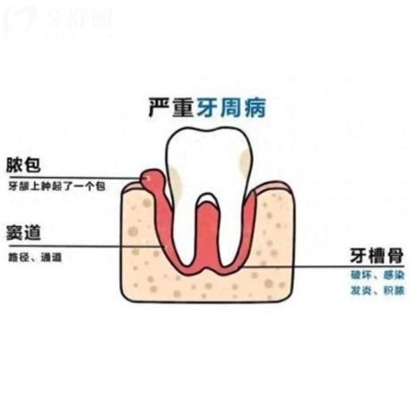 牙周治療有必要嗎？盤點常見牙周病以及診療方法