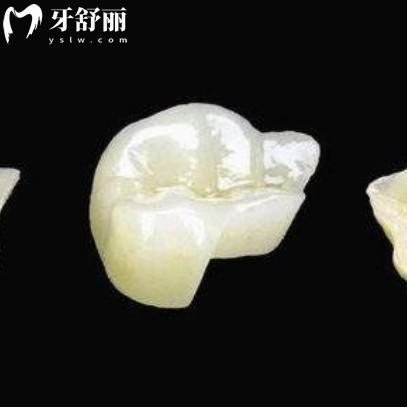牙冠和嵌體哪個(gè)實(shí)用性強(qiáng)？深度解析優(yōu)缺點(diǎn)/材質(zhì)/價(jià)目表等疑問