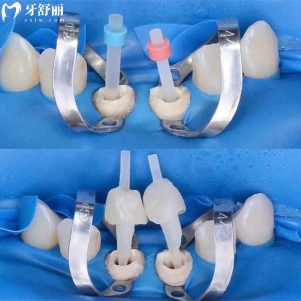 牙齒打樁的材料有哪些?分析鋼樁/鈦樁/瓷樁等5種材料優(yōu)缺點及價格