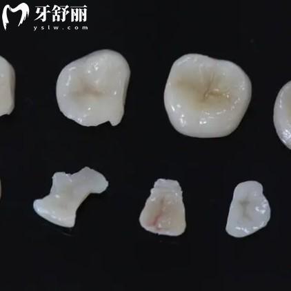嵌體有哪些材質(zhì)？哪種比較好？