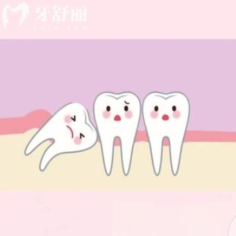 智齒每個人都會長嗎？如何判斷智齒位置還有拔牙指南全分享