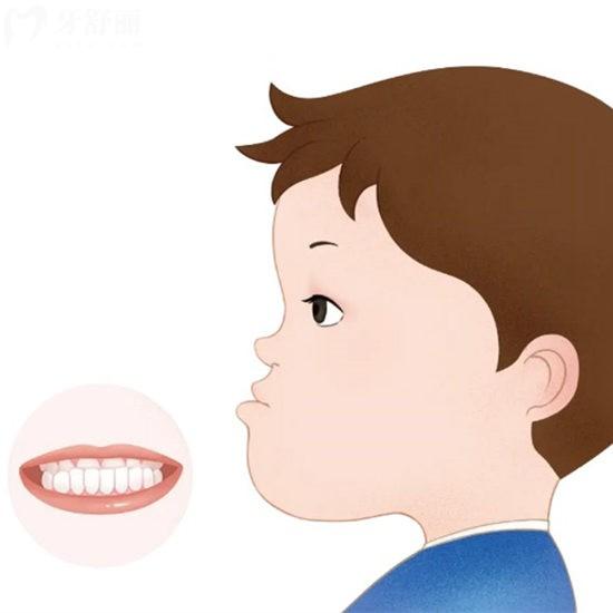 兒童反頜矯正需要多少錢?并介紹兒童反頜矯正的優(yōu)勢及較佳年齡