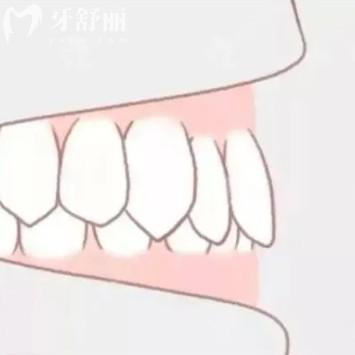 不影響美觀的深覆合還需要矯正嗎？如何分辨/危害/矯正法方式解答