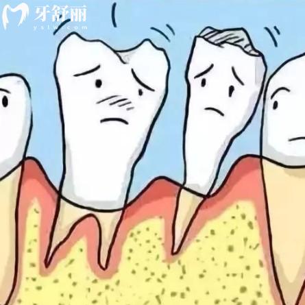 重度牙周炎牙齒松動還能治愈嗎？來看通常有哪幾種治療方法