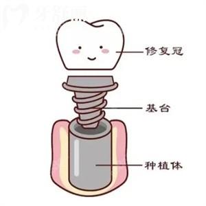 上海牙科種牙價(jià)格表公開(kāi)!/治療/種植牙費(fèi)用及醫(yī)生名單分享