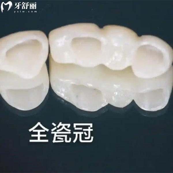 進(jìn)口全瓷牙冠品牌有哪些?德國(guó)澤康/美國(guó)LAVA/德國(guó)威蘭德牙冠優(yōu)勢(shì)及價(jià)格分析