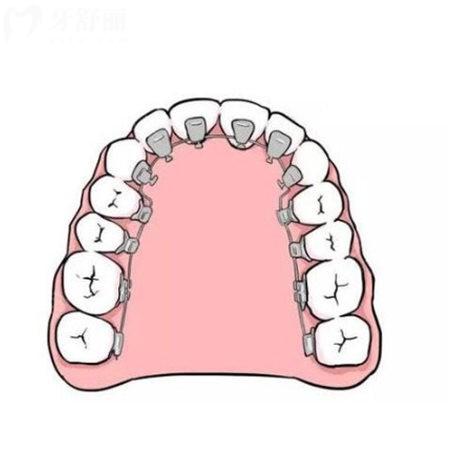 疑問(wèn)舌側(cè)矯正的價(jià)格是多少貴嗎?為啥舌側(cè)矯正很少人做?