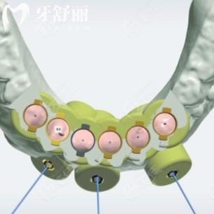 數(shù)字化種植牙和傳統(tǒng)種植牙哪個(gè)貴？