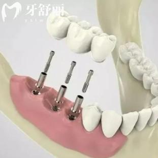 攻略整理：種植牙如何能省錢，從多方面解析種牙怎樣不被坑