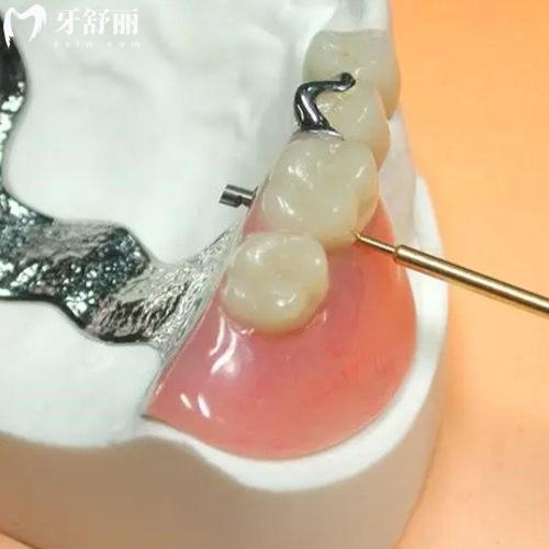 對比精密附著體義齒和吸附性義齒的區(qū)別在哪?看看如何選擇?