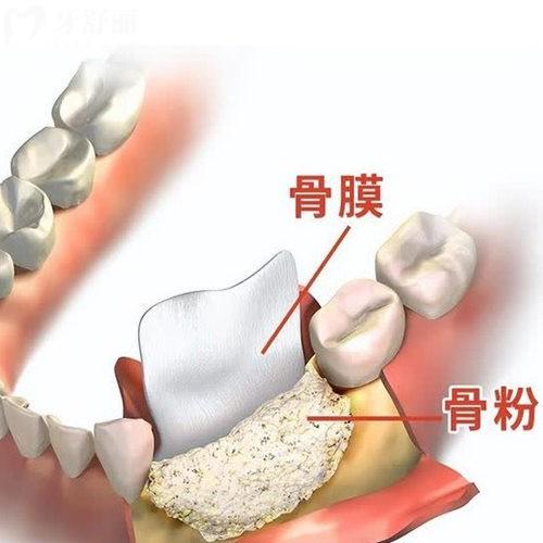 種牙用骨粉骨膜多長(zhǎng)時(shí)間能消腫?20天還沒(méi)有消腫正常嗎?
