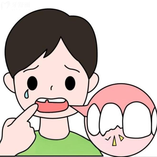 乳牙磕斷了一半怎么辦？直接拔掉還是修復(fù)？
