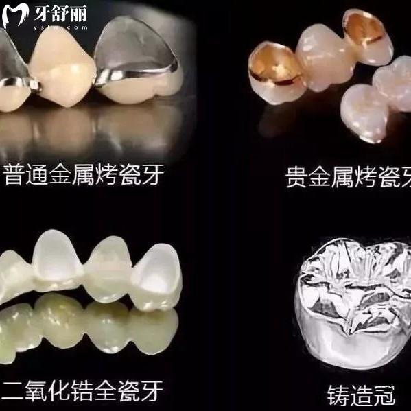 愛爾創(chuàng)全瓷牙冠質(zhì)保幾年？