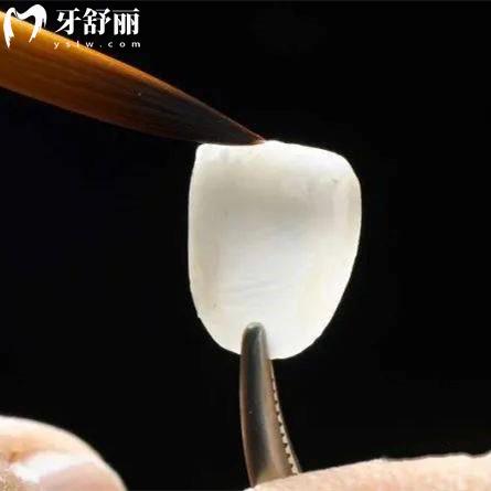 牙齒貼面時間長了會掉嗎