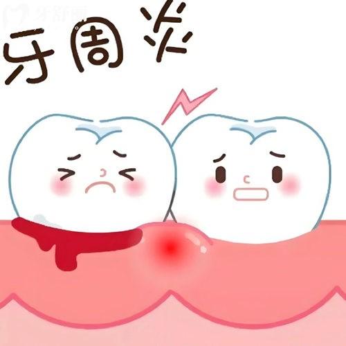 怎么判斷牙周炎的嚴(yán)重程度?牙周炎治療需要多長時(shí)間?一文帶你了解