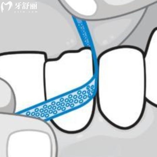 牙齒鄰面去釉對牙齒傷害大嗎？傷害不可逆可要注意啦