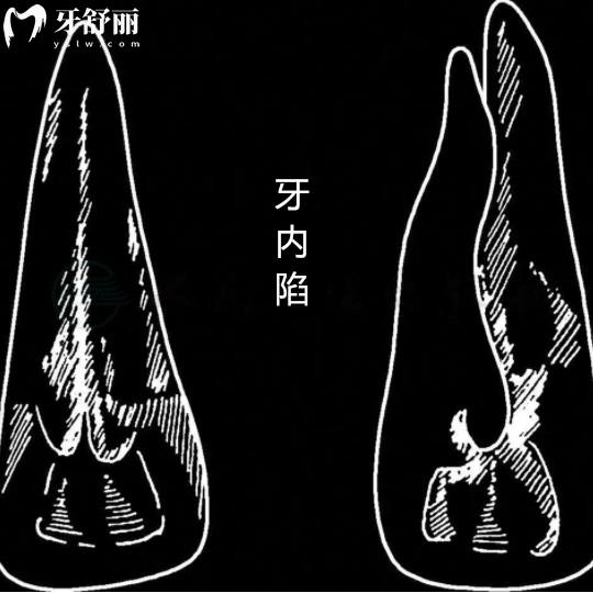 牙齒畸形牙內(nèi)陷是什么？不可忽視的牙齒發(fā)育畸形問題