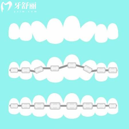 上海牙科正畸醫(yī)院排名一定要看:矯正好的鼎植/雅悅/拜博口腔矯正實力價格解析
