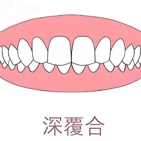 深覆合幾度怎么看的?這里手把手教你怎么判斷自己幾度深覆合?