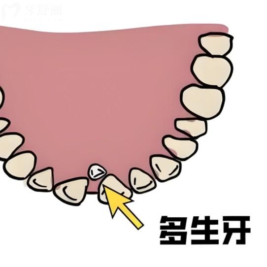 多生牙全年齡指南：兒童早發(fā)現(xiàn)，成人防病變，老人要當(dāng)心