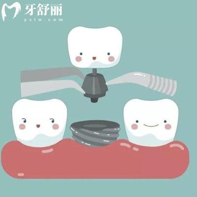 HIV患者能否進行種植牙手術(shù)?hiv患者做種植牙的注意事項請悉知