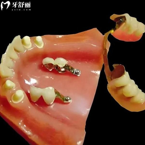 精密附著體需要每天拿下來嗎?需要,并分析精密附著體用著怎么樣及優(yōu)缺點(diǎn)