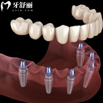種牙前要做哪些檢查，術(shù)前準(zhǔn)備工作看著一篇就夠