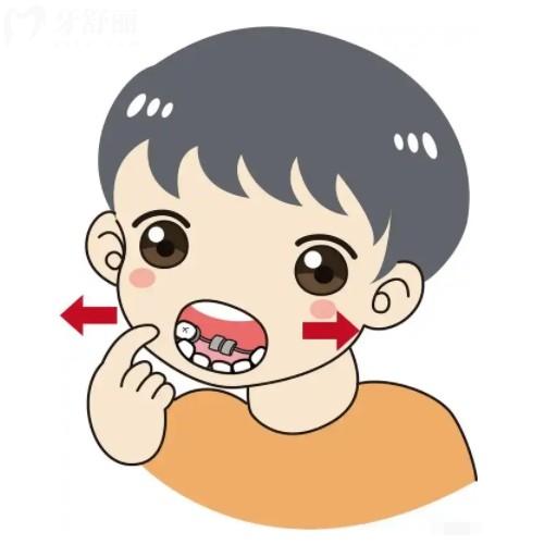 兒童下頜后縮矯正黃金年齡指南：不同階段治療要點(diǎn)全解析