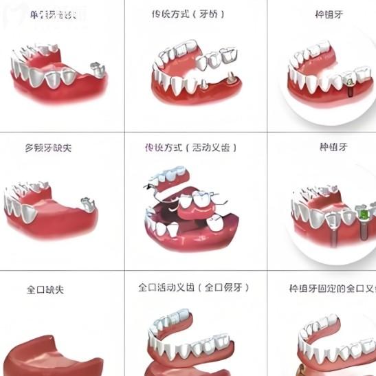 吸附性義齒、純鈦義齒、鈦合金義齒怎么選？?jī)?yōu)缺點(diǎn)對(duì)比看完就懂了