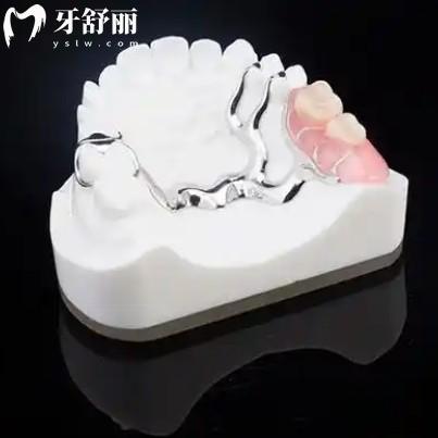 假牙支架選維他靈的還是純鈦的好？從價格優(yōu)勢和適用范圍對比