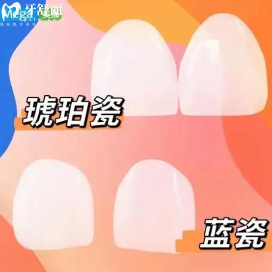 藍瓷貼面vs琥珀瓷貼面哪個好？一篇文章說透所有區(qū)別