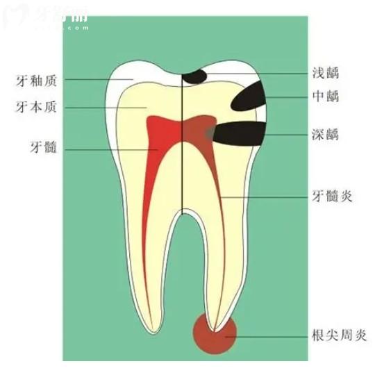 齲齒從深到淺發(fā)展歷程解讀，可別到最后一步才后悔