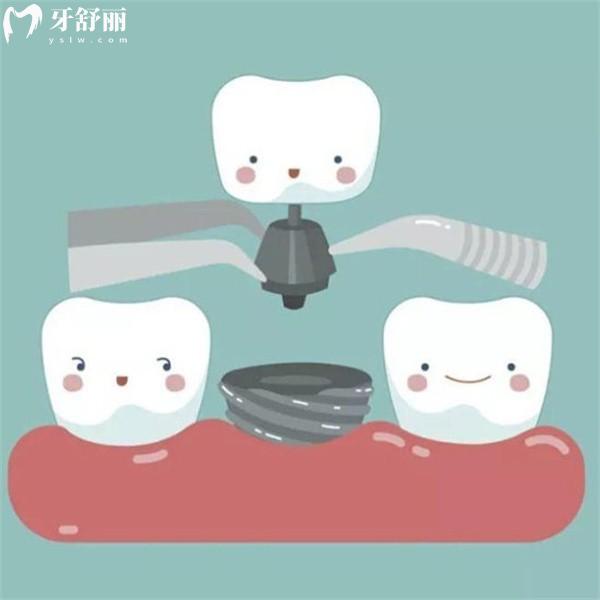 嘉興口腔醫(yī)院種植牙價(jià)格是多少？2025年新收費(fèi)標(biāo)準(zhǔn)及技術(shù)好的種植牙醫(yī)院大公開