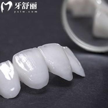 廣州瓷貼面找哪個(gè)醫(yī)院？排行榜前十都是有審美技術(shù)好的靠譜牙科